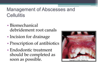 Management of Abscesses and
Cellulitis

• Biomechanical
  debridement root canals
• Incision for drainage
• Prescription of antibiotics
• Endodontic treatment
  should be completed as
  soon as possible.
 