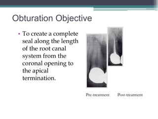 Obturation Objective
 • To create a complete
   seal along the length
   of the root canal
   system from the
   coronal opening to
   the apical
   termination.

                           Pre-treatment   Post-treatment
 