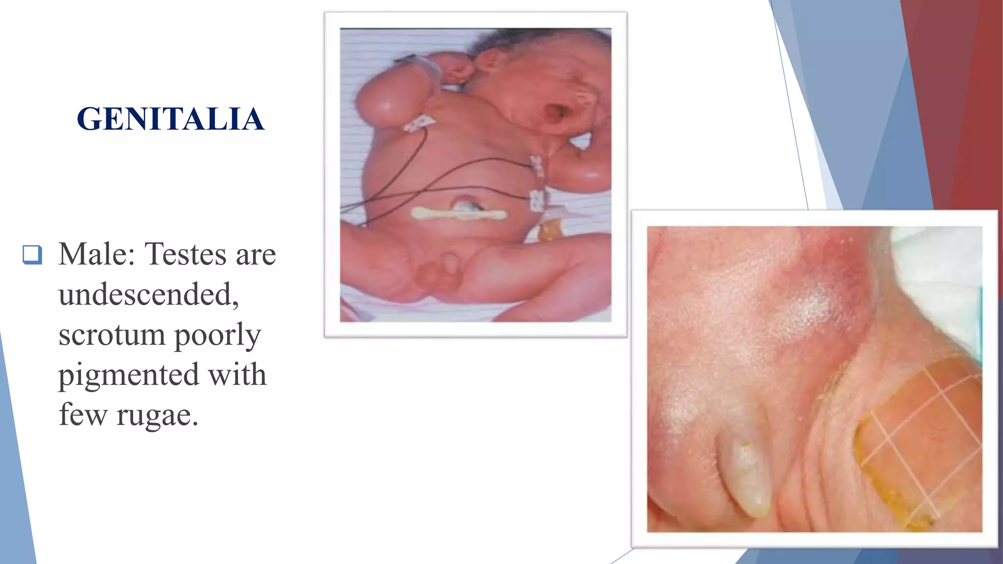 Preterm Neonate | PPTX