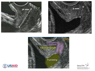 Вимірювання довжини шийки
Способи
 