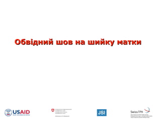 Обвідний шов на шийку маткиОбвідний шов на шийку матки
 