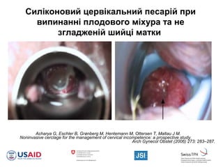 Acharya G, Eschler B, Grønberg M, Hentemann M, Ottersen T, Maltau J M.
Noninvasive cerclage for the management of cervical incompetence: a prospective study.
Arch Gynecol Obstet (2006) 273: 283–287.
Силіконовий цервікальний песарій при
випинанні плодового міхура та не
згладженій шийці матки
 