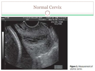 48
17P: Side Effects and Precautions
Precautions
 Discontinue if thrombosis or thromboembolism
occurs
 Consider discontinuing if allergic reactions occur
 Decreased glucose tolerance: Monitor pre-diabetic
and diabetic women
 Fluid retention: Monitor women with conditions that
may be affected by fluid retention, such as
preeclampsia, epilepsy, cardiac or renal dysfunction
 Depression: Monitor women with a history of clinical
depression; discontinue if depression recurs
MakenaTM Prescribing Information, Ther-Rx Corporation St. Louis, MO February, 2011
 