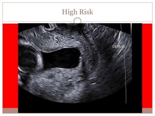 Cerclage Placement
Your text here
 