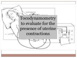 Tocodynamometry
to evaluate for the
presence of uterine
contractions
 