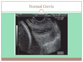 Normal Cervix
 