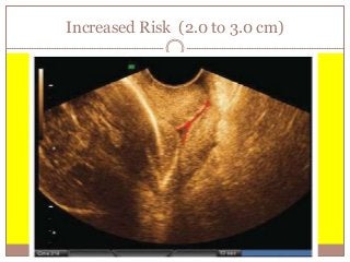 Increased Risk (2.0 to 3.0 cm)
 
