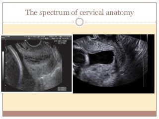 The spectrum of cervical anatomy
 