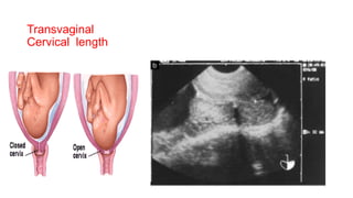 Transvaginal
Cervical length
 