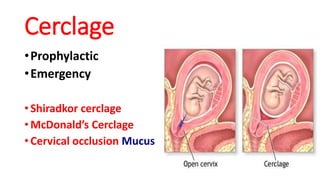 Cerclage
•Prophylactic
•Emergency
• Shiradkor cerclage
• McDonald’s Cerclage
• Cervical occlusion Mucus
 