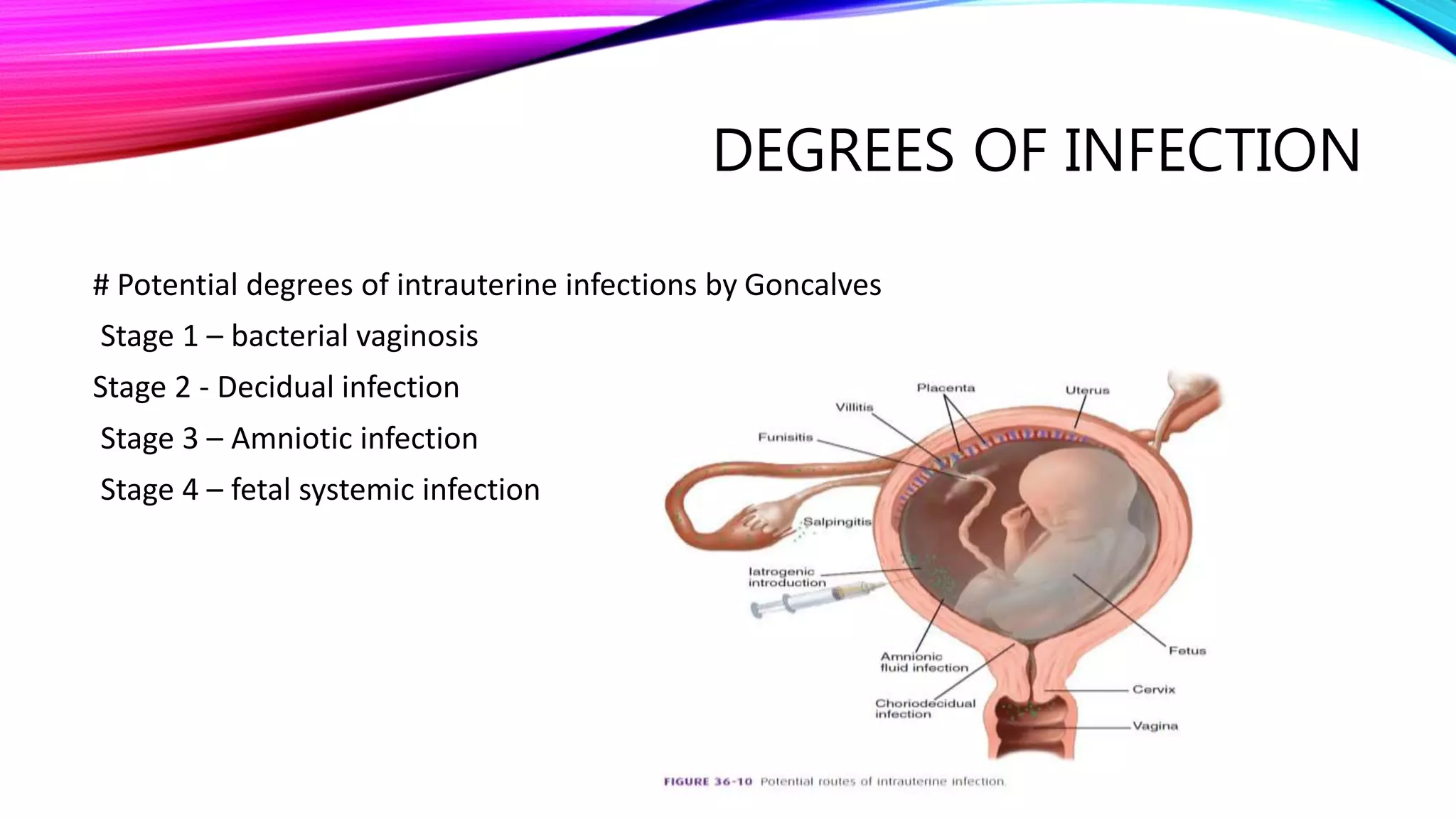 DEGREES OF INFECTION
# Potential degrees of intrauterine infections by Goncalves
Stage 1 – bacterial vaginosis
Stage 2 - Decidual infection
Stage 3 – Amniotic infection
Stage 4 – fetal systemic infection
 