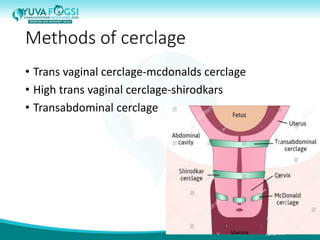 Methods of cerclage
• Trans vaginal cerclage-mcdonalds cerclage
• High trans vaginal cerclage-shirodkars
• Transabdominal cerclage
29
 