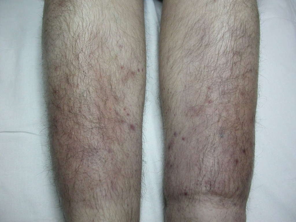 Pretibial myxedema wiyh graves disease[1].