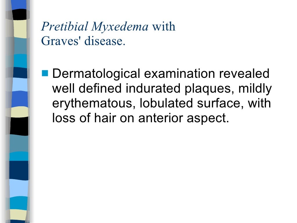 Pretibial myxedema wiyh graves disease[1].