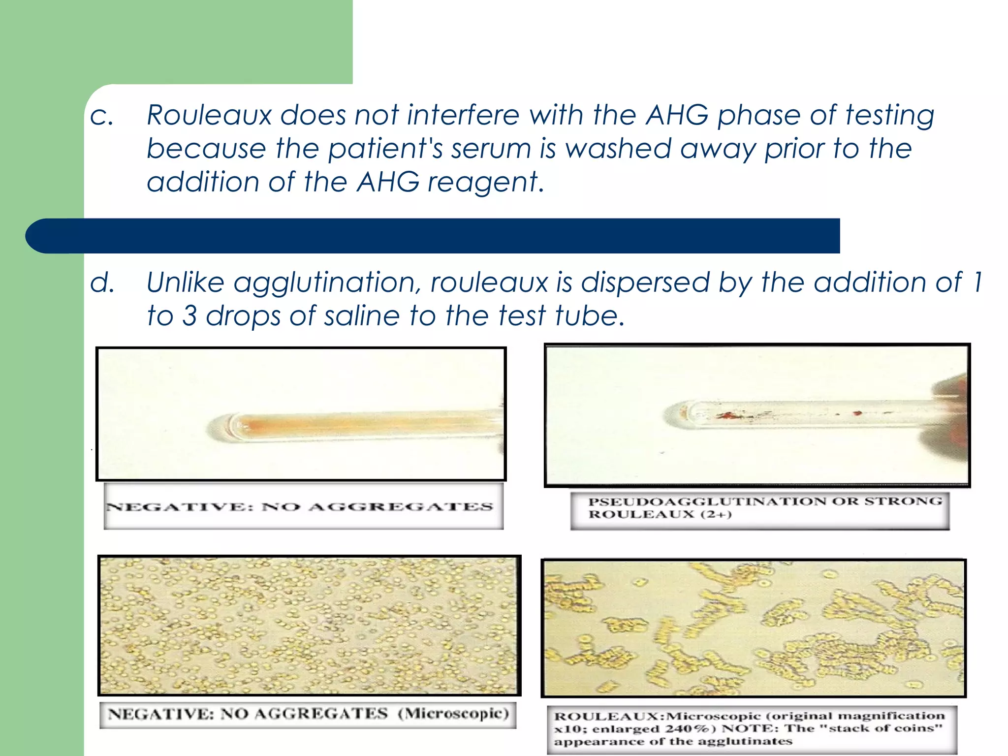 c. Rouleaux does not interfere with the AHG phase of testing
because the patient's serum is washed away prior to the
addition of the AHG reagent.
d. Unlike agglutination, rouleaux is dispersed by the addition of 1
to 3 drops of saline to the test tube.
 