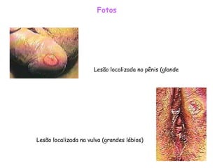 Fotos       Lesão localizada no pênis (glande Lesão localizada na vulva (grandes lábios)   