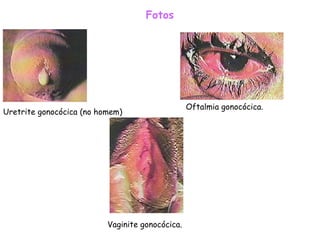 Fotos Uretrite gonocócica (no homem)  Vaginite gonocócica. Oftalmia gonocócica.  