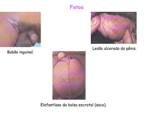 Fotos Bubão inguinal.  Lesão ulcerada do pênis.  Elefantíase da bolsa escrotal (saco).  