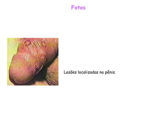 Fotos Lesões localizadas no pênis.    