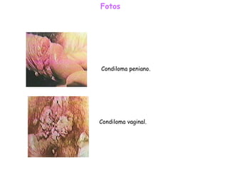                                 Condiloma peniano.                                  Condiloma vaginal.   Fotos 