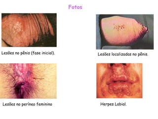 Fotos   Herpes Labial.    Lesões no pênis (fase inicial).    Lesões no períneo feminino   Lesões localizadas no pênis.  