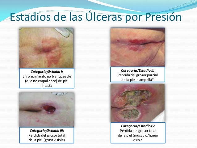 La rehabilitación después de la operación la tromboflebitis de las extremidades inferiores
