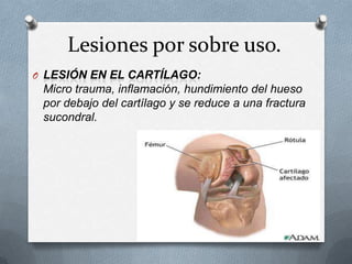 Lesiones por sobre uso.
O LESIÓN EN EL CARTÍLAGO:

Micro trauma, inflamación, hundimiento del hueso
por debajo del cartílago y se reduce a una fractura
sucondral.

 