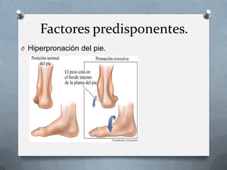 Factores predisponentes.
O Hiperpronación del pie.

 