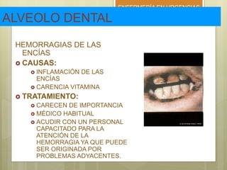 ENFERMERÍA EN URGENCIAS
ALVEOLO DENTAL
HEMORRAGIAS DE LAS
ENCÍAS
 CAUSAS:
 INFLAMACIÓN DE LAS
ENCÍAS
 CARENCIA VITAMINA
 TRATAMIENTO:
 CARECEN DE IMPORTANCIA
 MÉDICO HABITUAL
 ACUDIR CON UN PERSONAL
CAPACITADO PARA LA
ATENCIÓN DE LA
HEMORRAGIA YA QUE PUEDE
SER ORIGINADA POR
PROBLEMAS ADYACENTES.
 