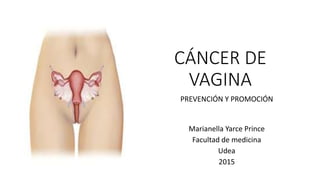 CÁNCER DE
VAGINA
PREVENCIÓN Y PROMOCIÓN
Marianella Yarce Prince
Facultad de medicina
Udea
2015
 