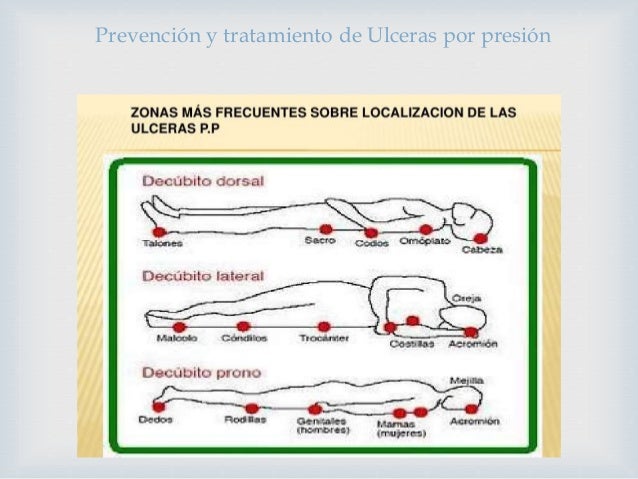 Prevención y tratamiento de ulceras por presión