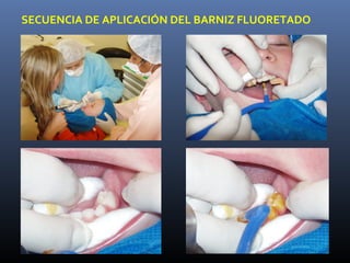 SECUENCIA DE APLICACIÓN DEL BARNIZ FLUORETADO
 