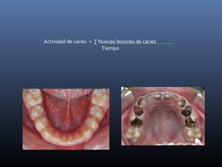 Actividad de caries = ∑ Nuevas lesiones de caries
                         Tiempo
 