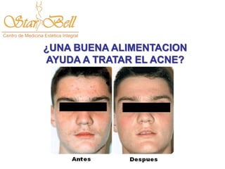 ¿UNA BUENA ALIMENTACION
AYUDA A TRATAR EL ACNE?
 