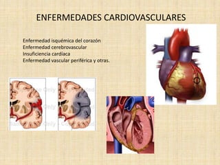 ENFERMEDADES CARDIOVASCULARES

Enfermedad isquémica del corazón
Enfermedad cerebrovascular
Insuficiencia cardíaca
Enfermedad vascular periférica y otras.
 