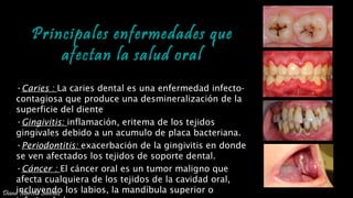 PREVENCIÓN DE ENFERMEDADES DENTALES
Principales enfermedades que
afectan la salud oral
•Caries : La caries dental es una enfermedad infecto-
contagiosa que produce una desmineralización de la
superficie del diente
•Gingivitis: inflamación, eritema de los tejidos
gingivales debido a un acumulo de placa bacteriana.
•Periodontitis: exacerbación de la gingivitis en donde
se ven afectados los tejidos de soporte dental.
•Cáncer : El cáncer oral es un tumor maligno que
afecta cualquiera de los tejidos de la cavidad oral,
incluyendo los labios, la mandíbula superior oDiana Marcela Sánchez
 