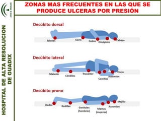 HOSPITALDEALTARESOLUCION
DEGUADIX
ZONAS MAS FRECUENTES EN LAS QUE SE
PRODUCE ULCERAS POR PRESIÓN
 