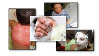 Prevención Integral de Quemaduras en Niños: Seguridad en el Hogar y ...