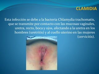 Esta infección se debe a la bacteria Chlamydia trachomatis,
que se transmite por contacto con las mucosas vaginales,
uretra, recto, boca y ojos, afectando a la uretra en los
hombres (uretritis) y al cuello uterino en las mujeres
(cervicitis).
 