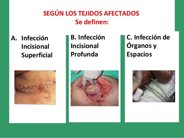 PREVENCION DE INFECCIONES DE SITIO QUIRURGICO