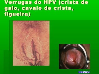 Verrugas do HPV (crista deVerrugas do HPV (crista de
galo, cavalo de crista,galo, cavalo de crista,
figueira)figueira)
 