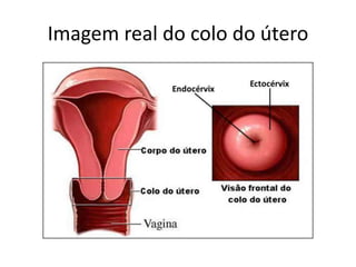 Imagem real do colo do útero
 