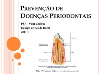 PREVENÇÃO DE
DOENÇAS PERIODONTAIS
PSF – Vilar Carioca
Equipe de Saúde Bucal
2011.1




          Fig.1- Periodonto Sadio (www. ortodonciadultos.com, 2011)
 