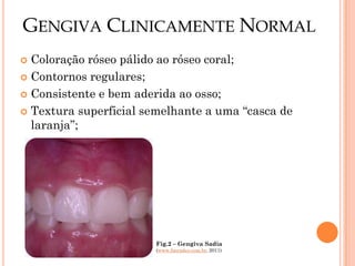 GENGIVA CLINICAMENTE NORMAL
 Coloração róseo pálido ao róseo coral;
 Contornos regulares;

 Consistente e bem aderida ao osso;

 Textura superficial semelhante a uma “casca de
  laranja”;




                       Fig.2 – Gengiva Sadia
                       (www.fmendes.com.br, 2011)
 