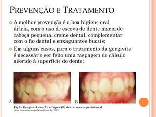 PREVENÇÃO E TRATAMENTO
 A melhor prevenção é a boa higiene oral
  diária, com o uso de escova de dente macia de
  cabeça pequena, creme dental, complementar
  com o fio dental e enxaguantes bucais;
 Em alguns casos, para o tratamento da gengivite
  é necessário ser feito uma raspagem do cálculo
  aderido à superfície do dente;




A                                                 B
    Fig.5 – Gengiva Antes (A) e Depois (B) do tratamento periodontal
    (www.odontologiaespecializada.com.br, 2011)
 