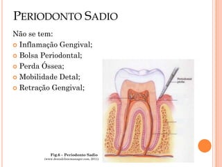 PERIODONTO SADIO
Não se tem:
 Inflamação Gengival;

 Bolsa Periodontal;

 Perda Óssea;

 Mobilidade Detal;

 Retração Gengival;




           Fig.6 – Periodonto Sadio
        (www.dentalclinicmanager.com, 2011)
 