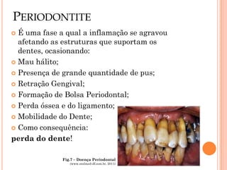 PERIODONTITE
 É uma fase a qual a inflamação se agravou
  afetando as estruturas que suportam os
  dentes, ocasionando:
 Mau hálito;

 Presença de grande quantidade de pus;

 Retração Gengival;

 Formação de Bolsa Periodontal;

 Perda óssea e do ligamento;

 Mobilidade do Dente;

 Como consequência:

perda do dente!

              Fig.7 – Doença Periodontal
                 (www.oralmed-df.com.br, 2011)
 