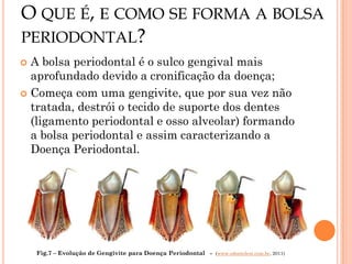 O QUE É, E COMO SE FORMA A BOLSA
PERIODONTAL?
 A bolsa periodontal é o sulco gengival mais
  aprofundado devido a cronificação da doença;
 Começa com uma gengivite, que por sua vez não
  tratada, destrói o tecido de suporte dos dentes
  (ligamento periodontal e osso alveolar) formando
  a bolsa periodontal e assim caracterizando a
  Doença Periodontal.




    Fig.7 – Evolução de Gengivite para Doença Periodontal - (www.odontolest.com.br, 2011)
 