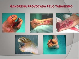 GANGRENA PROVOCADA PELO TABAGISMO
 