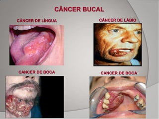 CÂNCER BUCAL
CÂNCER DE LÍNGUA         CÂNCER DE LÁBIO




CANCER DE BOCA            CANCER DE BOCA
 
